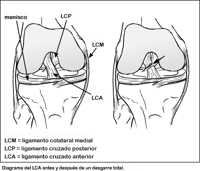  Rodillera articulada para hombres y mujeres, soporte de rodilla  para inflamación del ligamento cruzado anterior o lesiones del tendón,  ligamento y menisco., S : Salud y Hogar