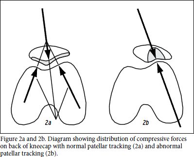 kneecap patella pain