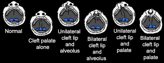 Different Types of Cleft Lip and/or Cleft Palate