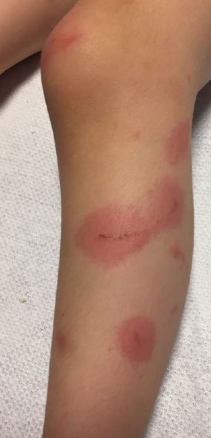 If your child touches a poison ivy plant or touches something that has the plant's oil on it, their skin should be washed immediately. The skin can be washed with soap or dishwashing detergent. It should be rinsed with cool water to remove the soap or detergent to avoid irritation. Wash the skin gently and do not scrub. Scrubbing the skin can spread the plant's oil. Be sure to wash under the nails, as oil can get trapped there.