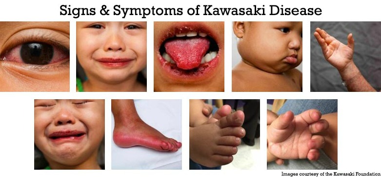 Signs & Symptoms: Kawasaki Disease 
