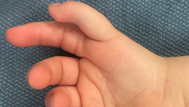 Small (Hypoplastic) Thumb - Example