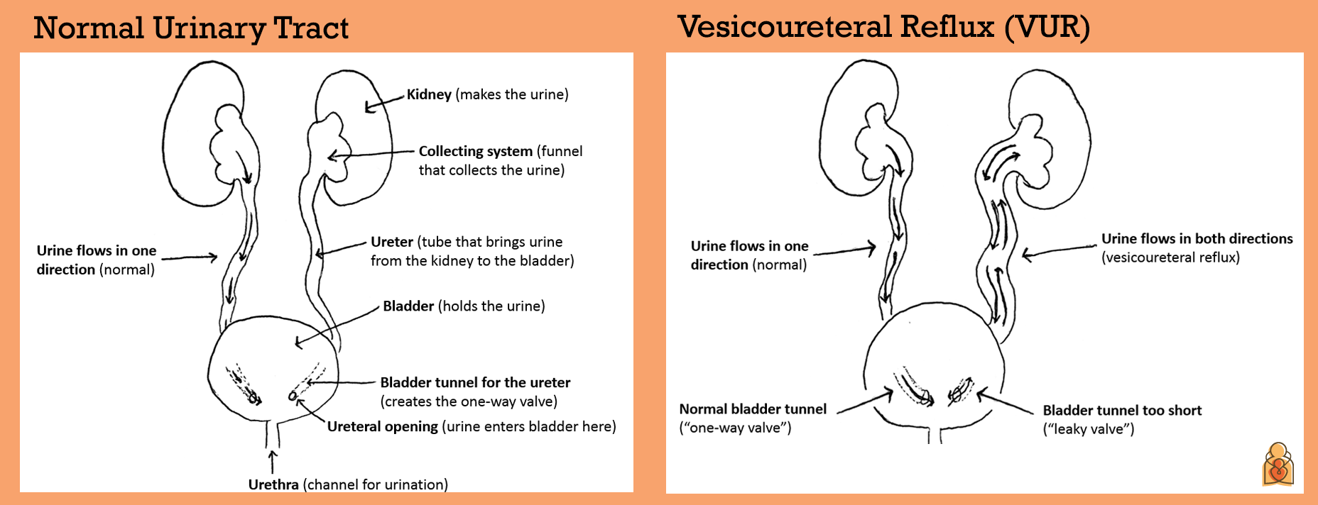 Diagram - Normal Urinary Tract vs. Vesicoureteral Reflux