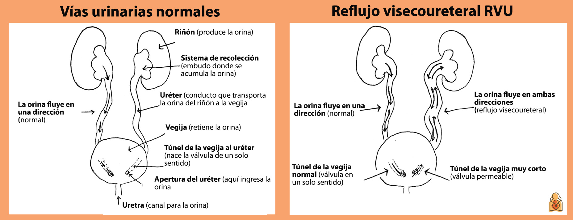 Comparación vías urinarias normales y con RVU