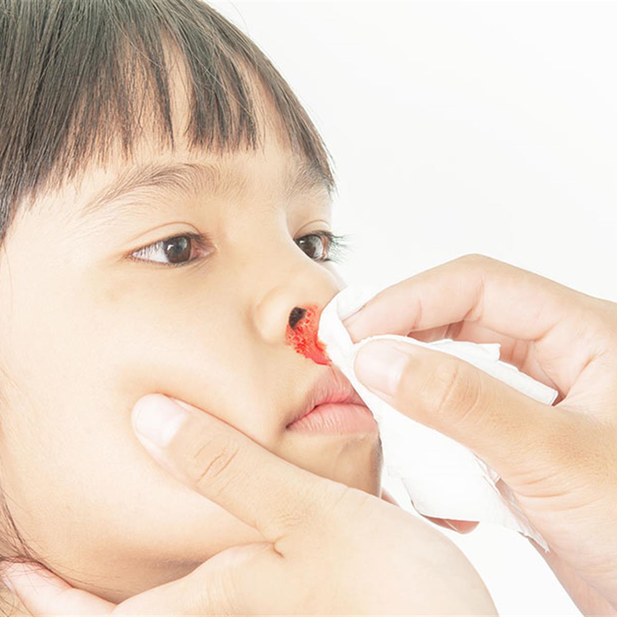 How to stop a nosebleed: Tips and treatment