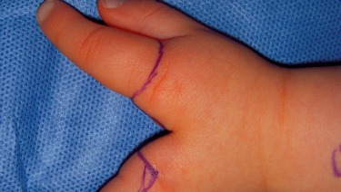 Cleft Hand - Example
