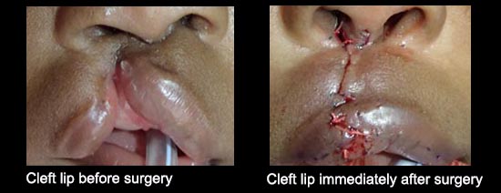 Before cleft lip surgery and immediately after