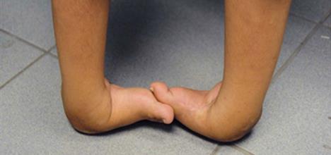 Newborn Feet: Common Deformities 