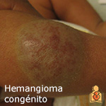 Hemangioma congénito