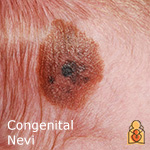 Congenital Nevi - HealthyChildren.org