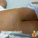 Melanocitosis dérmica