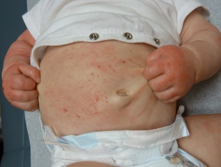 How to Treat and Control Eczema Rashes in Children – My Blog