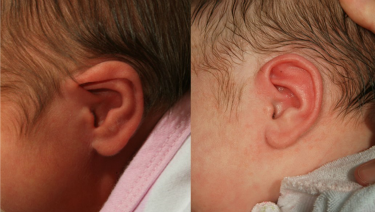 Sound Options: Treating Abnormal Ear Shape in Infants and Children