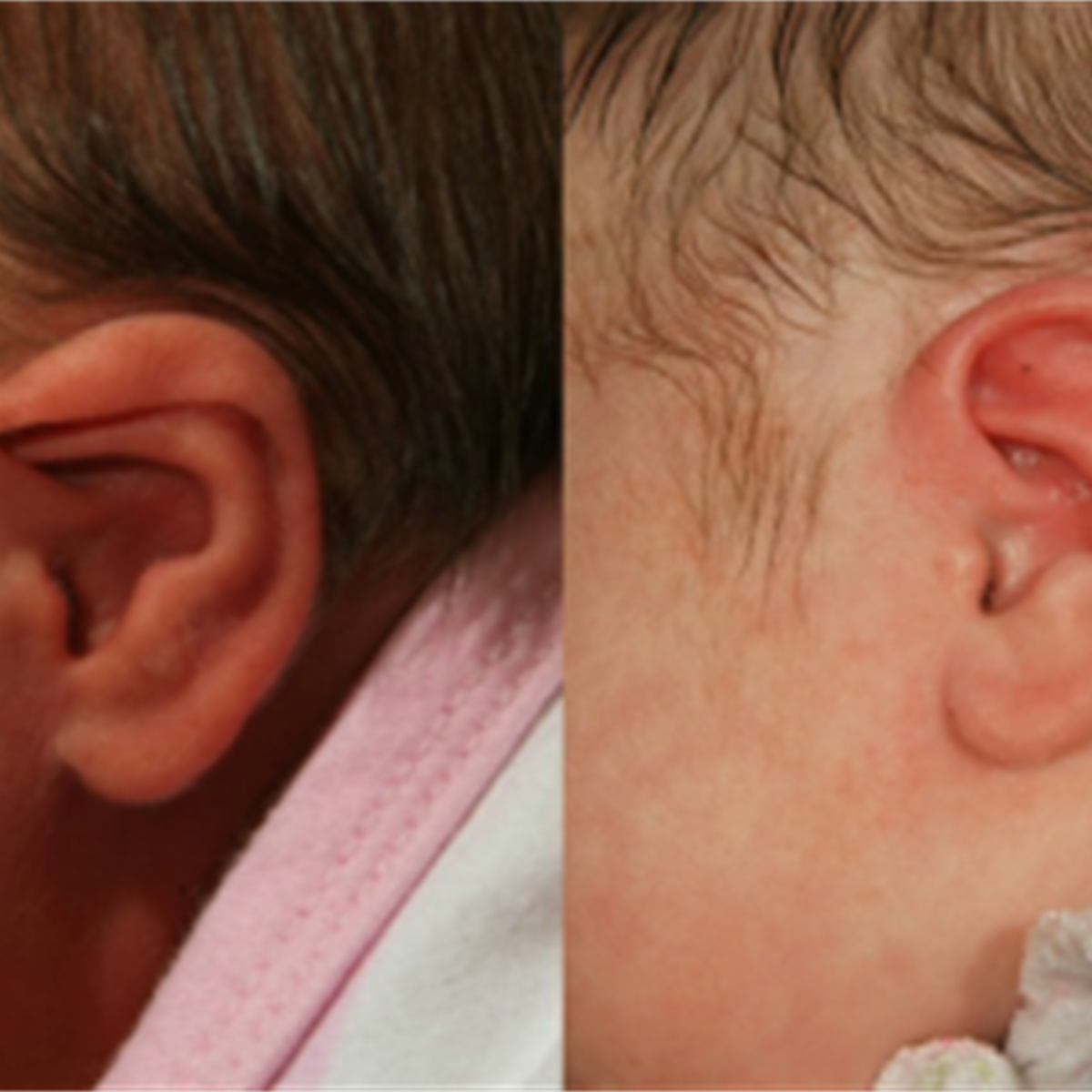 Opciones para el tratamiento de orejas con formas anormales en bebés y  niños 