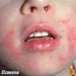 Eczema - Image - HealthyChildren.org