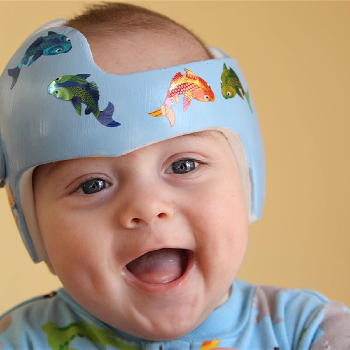 Bebé tiene que usar un casco por plagiocefalia y su familia decide hacer lo  mismo