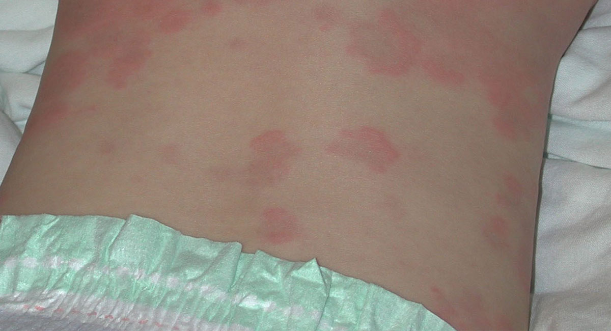 Hives Urticaria In Children HealthyChildren