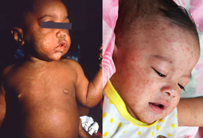 measles-examples