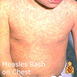 Protecting Your Baby from a Measles Outbreak FAQs