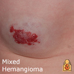 Mixed Hemangiomas