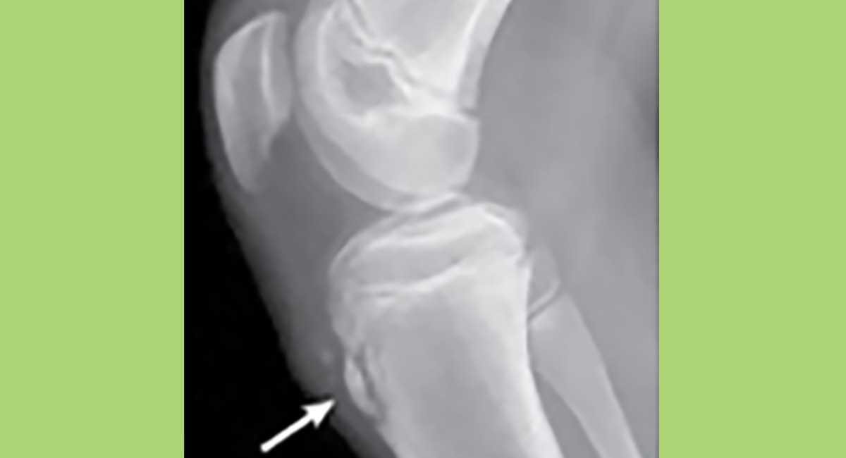 Knee Pain and Osgood Schlatter Disease HealthyChildren