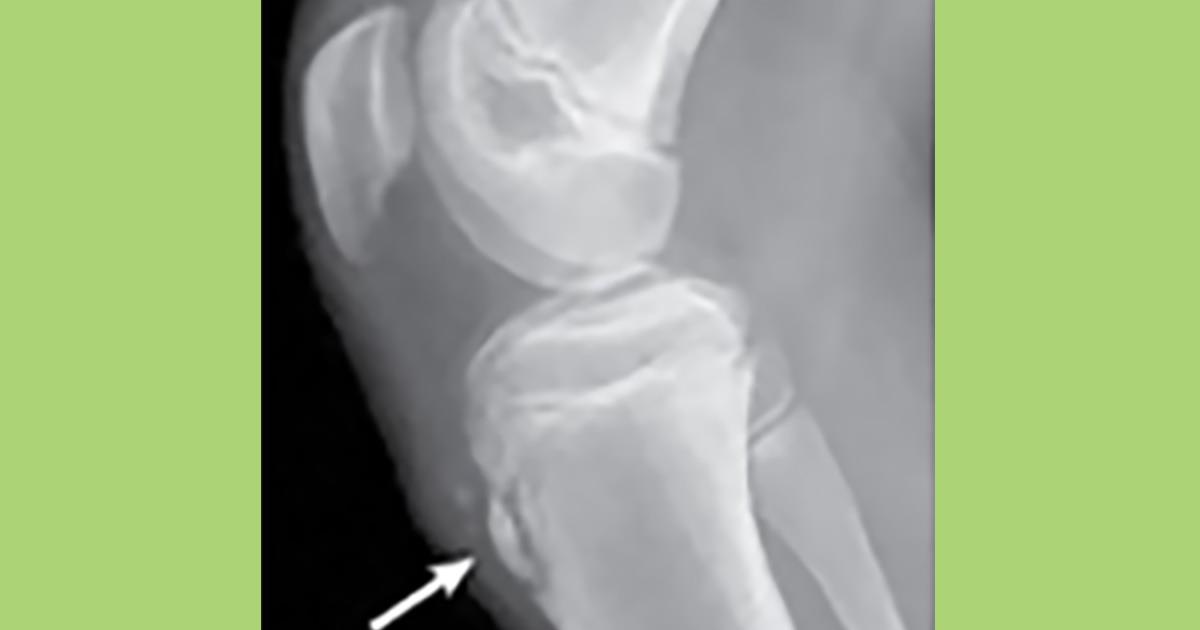 Knee Pain and Osgood-Schlatter Disease - HealthyChildren.org