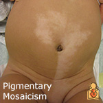 Mosaicism - HealthyChildren.org