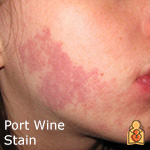 Port wine stain - HealthyChildren.org