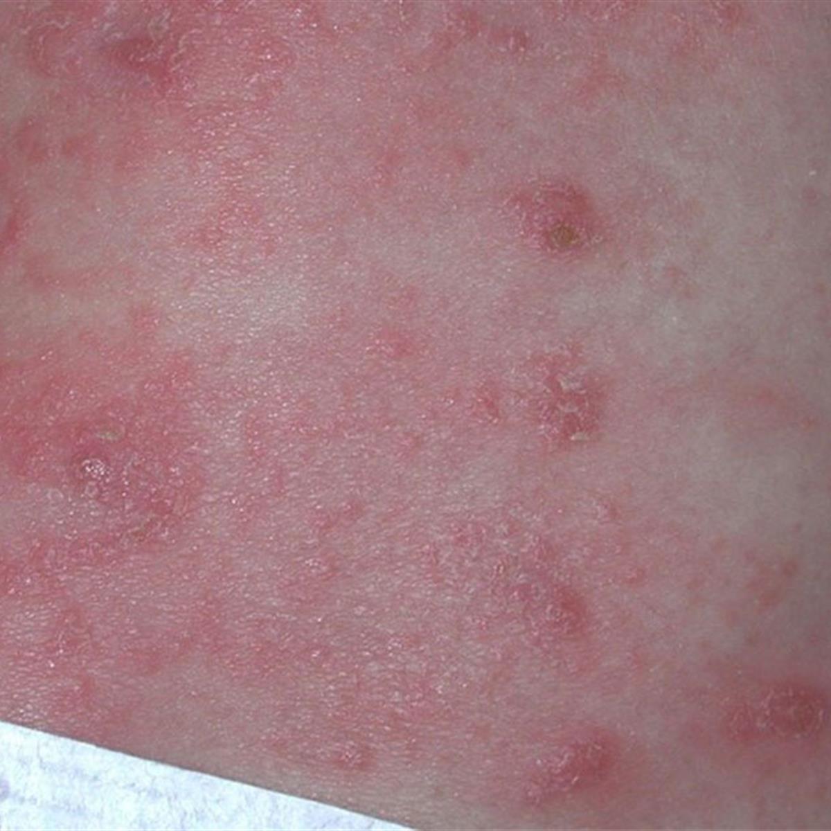 scabies rash on stomach