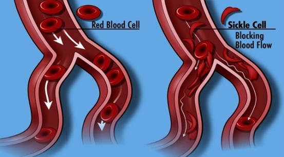 children with sickle cell anemia