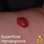 Superficial Hemangiomas