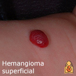 Hemangioma superficial