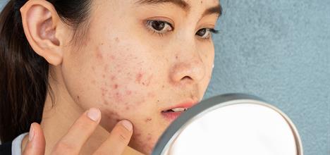 Teen Acne: How to Treat & Prevent This Common Skin Condition 
